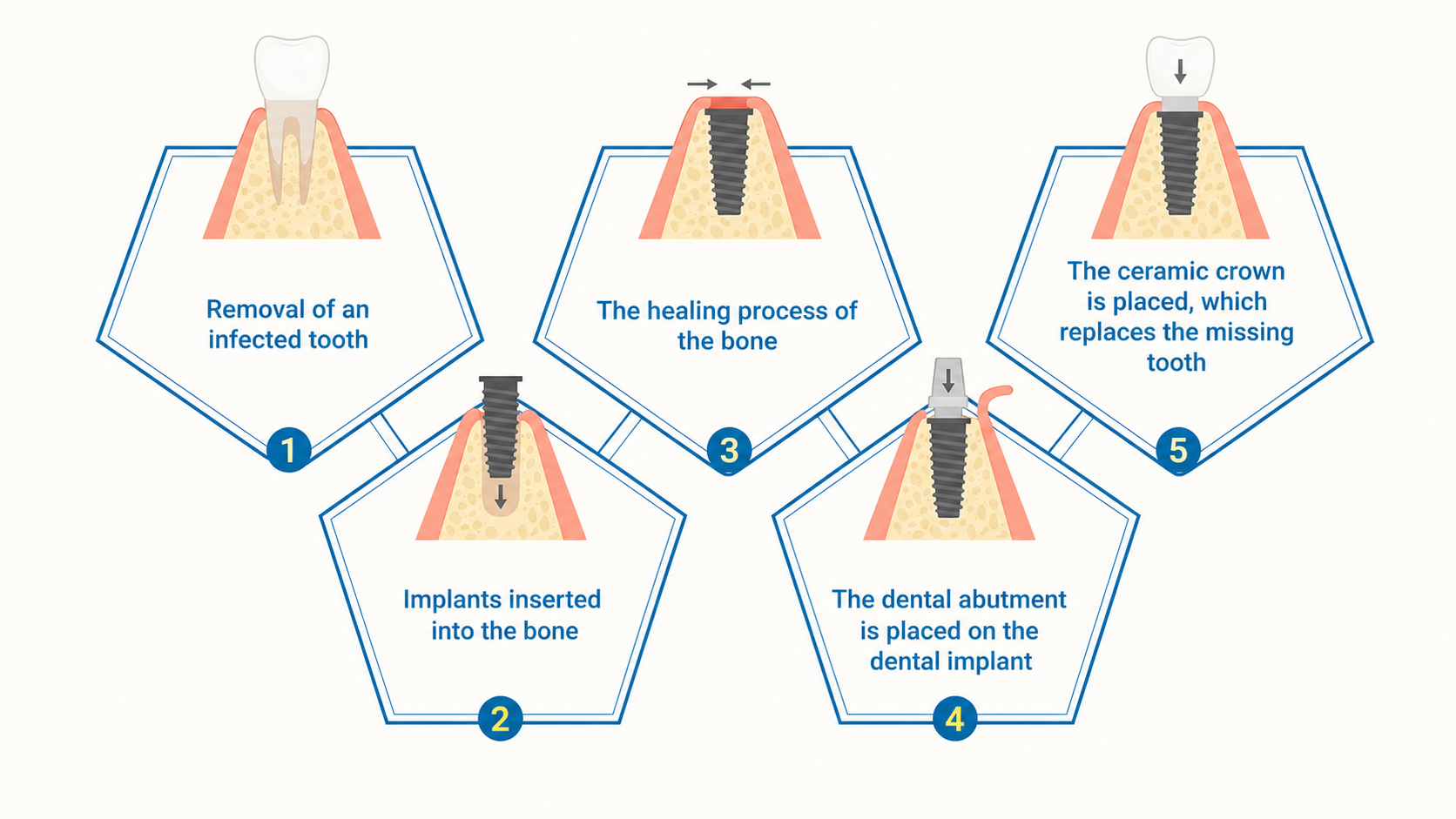 Dental Implants in Welland: A step in the treatment process
