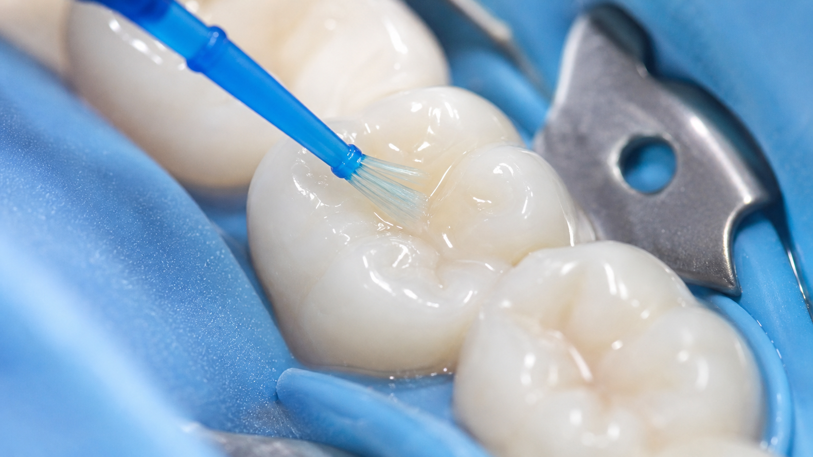 Dental Sealants in Welland: A step in the treatment process