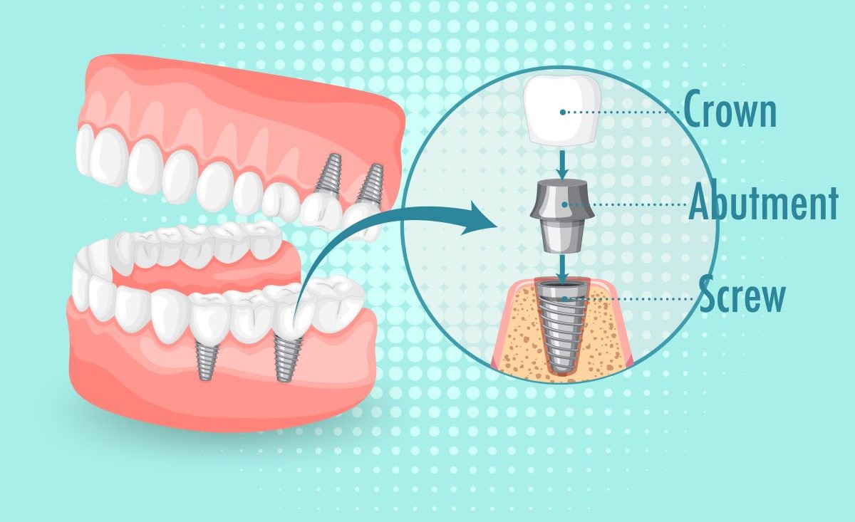 Dental Implants at Aroma Dental in Humble, TX: a dentist explaining a dental implant model with titanium post and ceramic crown to a patient