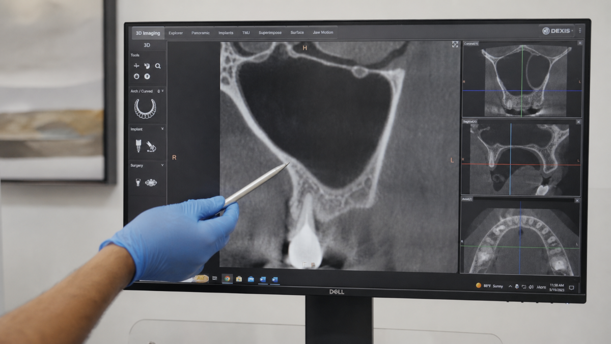 Sinus Lift at Aroma Dental in Humble, TX: an implant dentist reviewing 3D scans while planning a sinus lift bone graft
