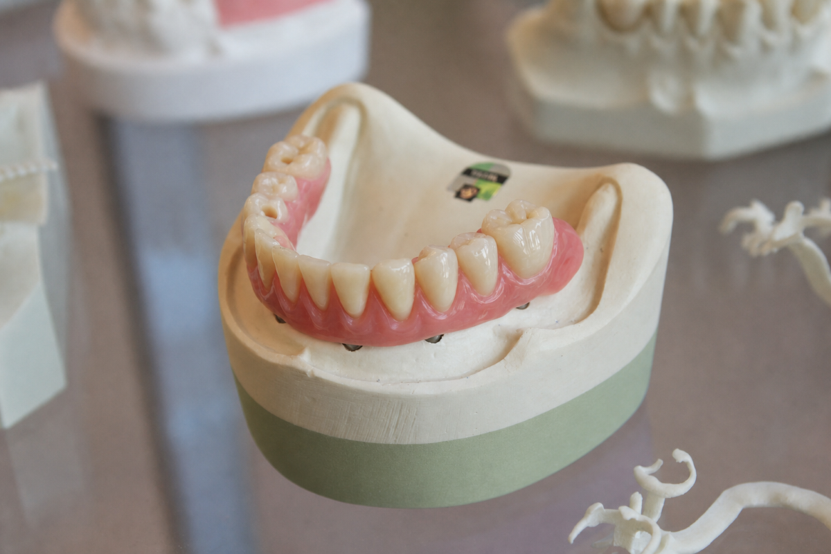 Overdentures in Guelph