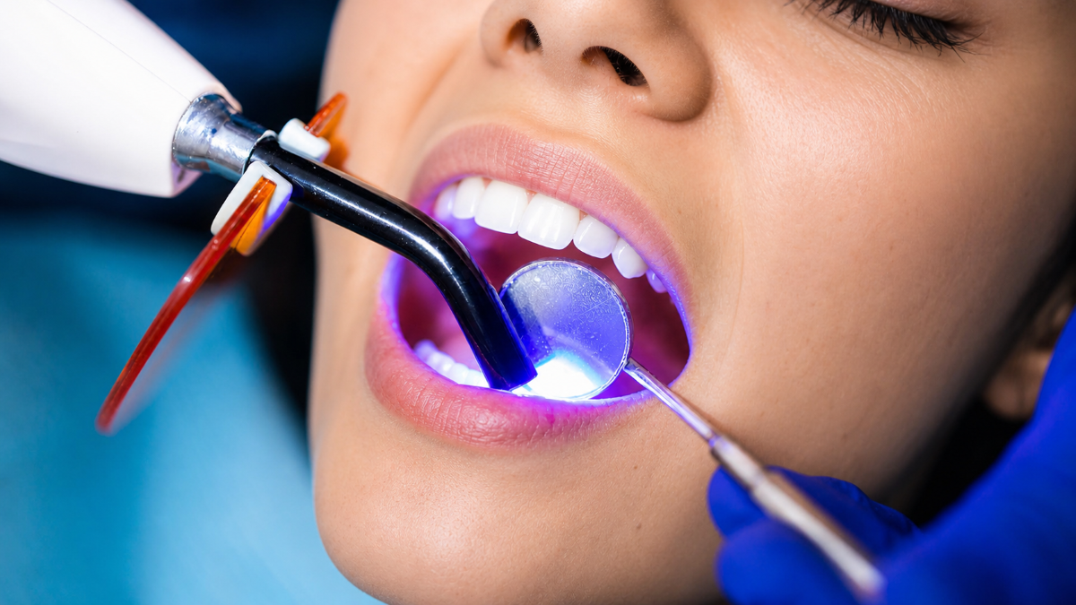 Tooth Fillings in Guelph
