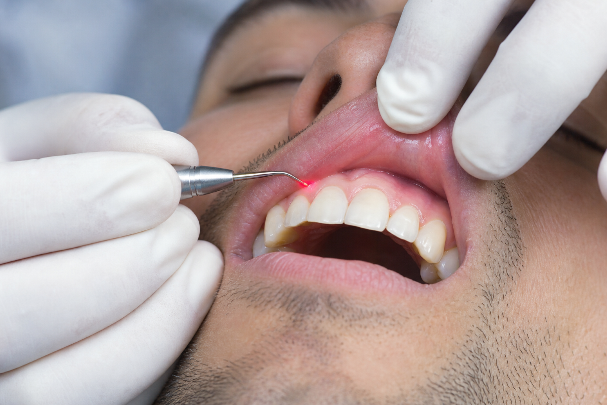 Laser Gum Contouring and Shaping in Waterloo