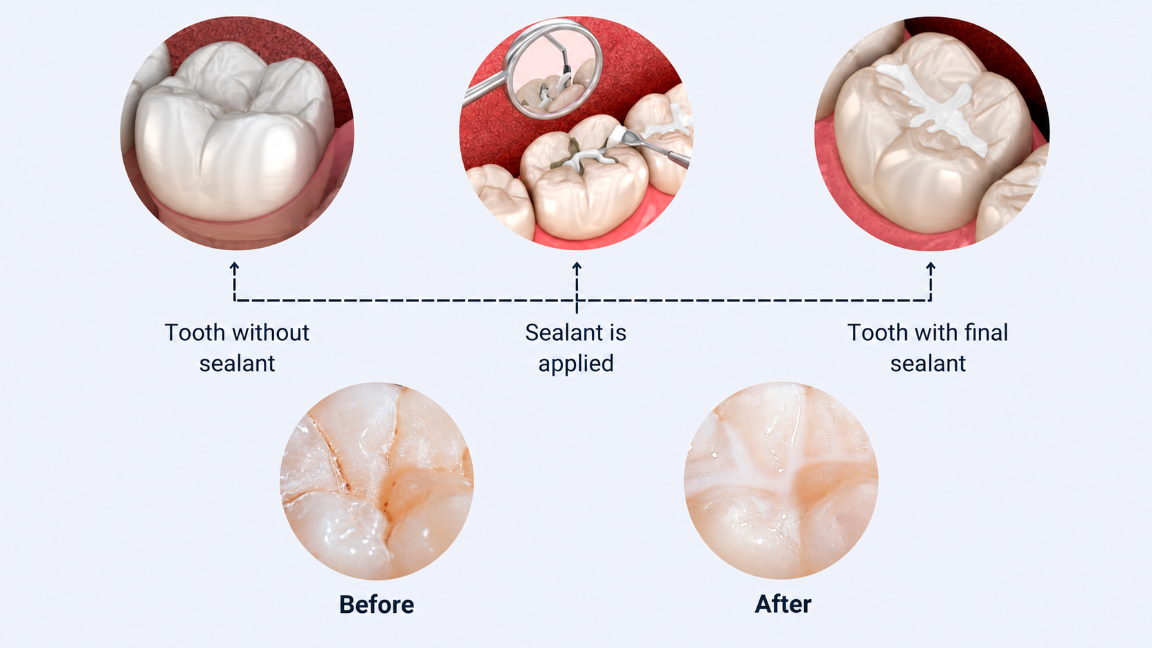 When It Is Applied | Dental Sealants in Waterloo, ON — Westmount Dental When It Is Applied — Dental Sealants at Westmount Dental in Waterloo, ON