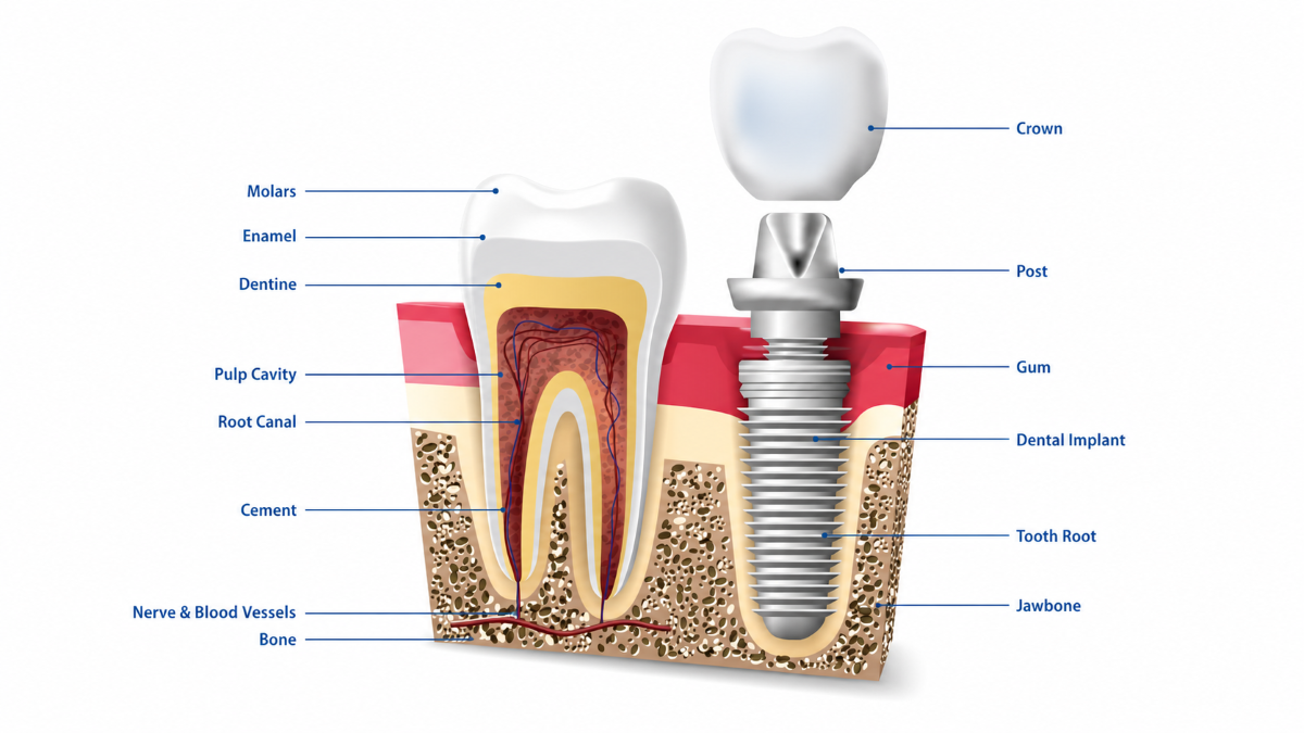 Implant, Bridge, or Denture? — Dental Implants at Westmount Dental in Waterloo, ON