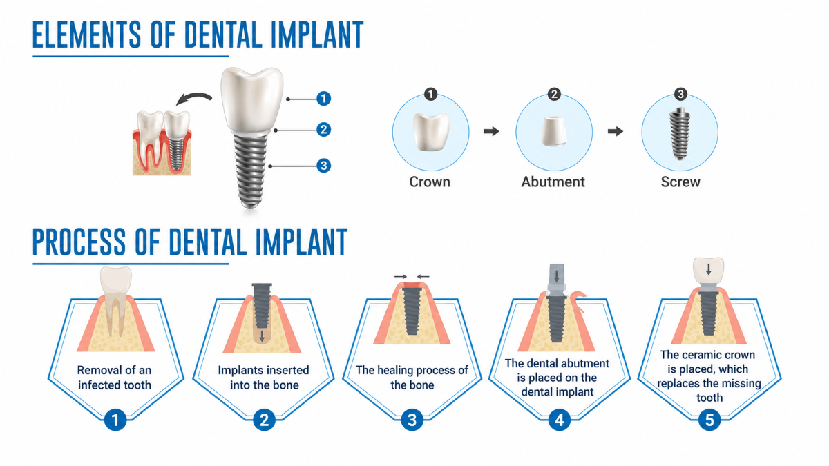 Diagram of dental implant post, abutment and crown components in Nobleton, ON