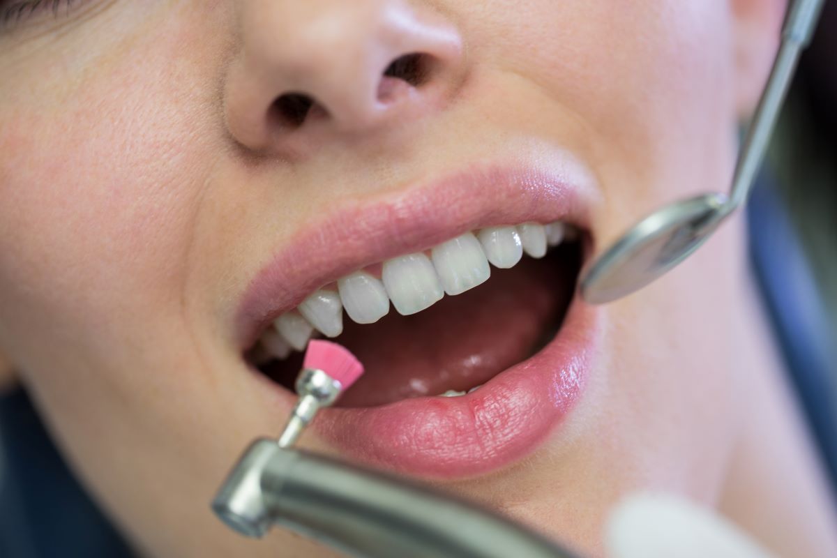 Teeth Cleaning in Nobleton, ON