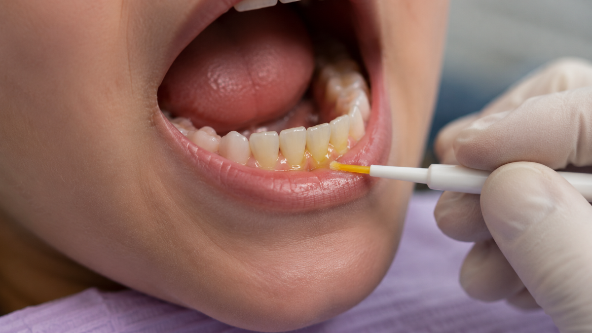 Fluoride varnish applied to exposed tooth roots for sensitivity relief in Nobleton, ON